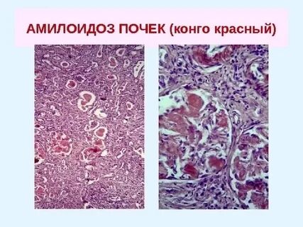 Почечный амилоидоз