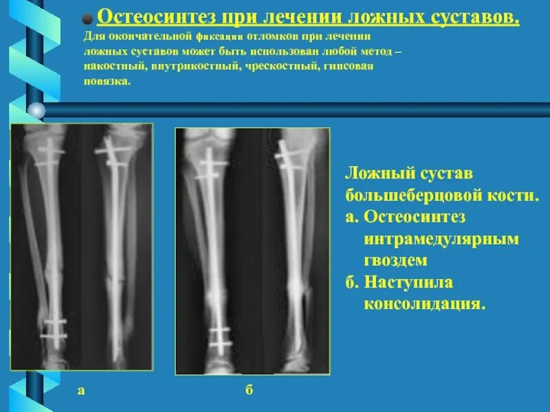 Интрамедуллярный (внутрикостный) остеосинтез большеберцовой кости. Псевдоартроз большеберцовой кости рентген. Биос остеосинтез большеберцовой кости. Ложный сустав бедренной кости операция. Осложнения остеосинтеза