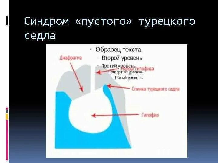 Формирующееся турецкое седло в головном мозге