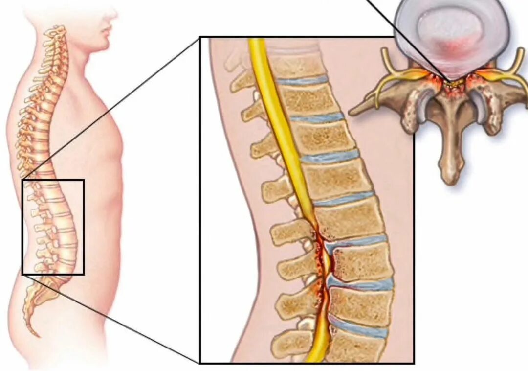 Степени стеноза позвоночного канала поясничного отдела мрт. Стеноз позвоночного канала l2-l3. Межпозвоночная грыжа шейного отдела мрт. Грыжа шейного отдела позвоночника мрт. Позвоночный канал шейного отдела позвоночника.