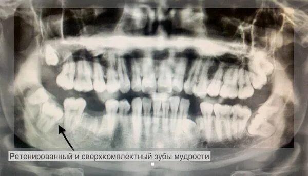 Дистопированный зуб мкб 10. Сверхкомплектный зуб в верхней челюсти. сверхкомплектный зуб мкб 10. сверхкомплектный зуб между резцами. ретинированный дистопированный зуб мудрости.