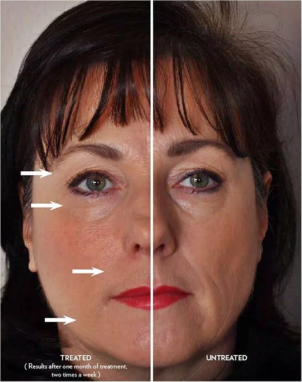 Микротоки лицо до и после фото отзывы. Микротоки для лица результат. микротоки для лица до и после. микротоки для лица фото до и после. миостимуляция лица до и после.