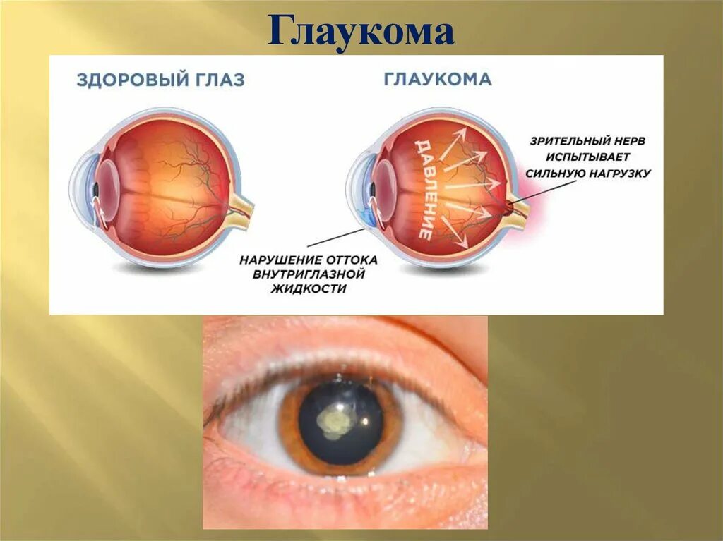 Глаза давление сильное. Глаза катаракта глаукома. Здоровые глаза.