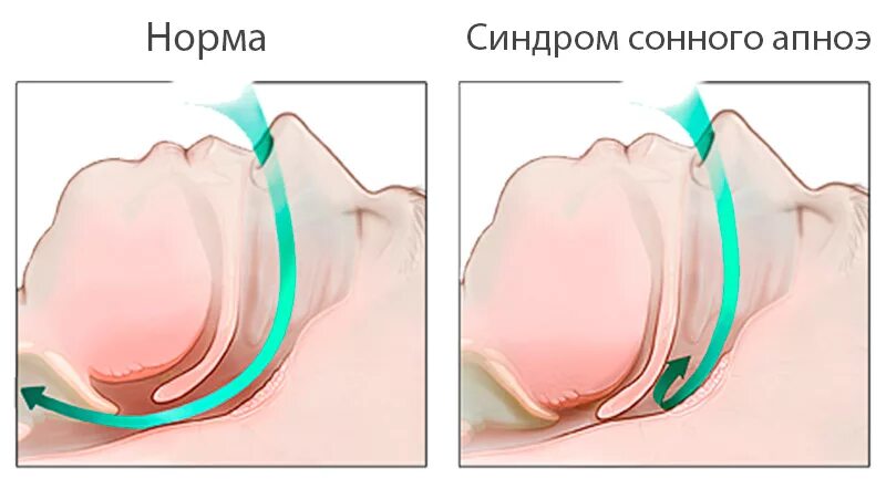 Синдром обструктивного апноэ сна. Синдром обструктивного апноэ сна