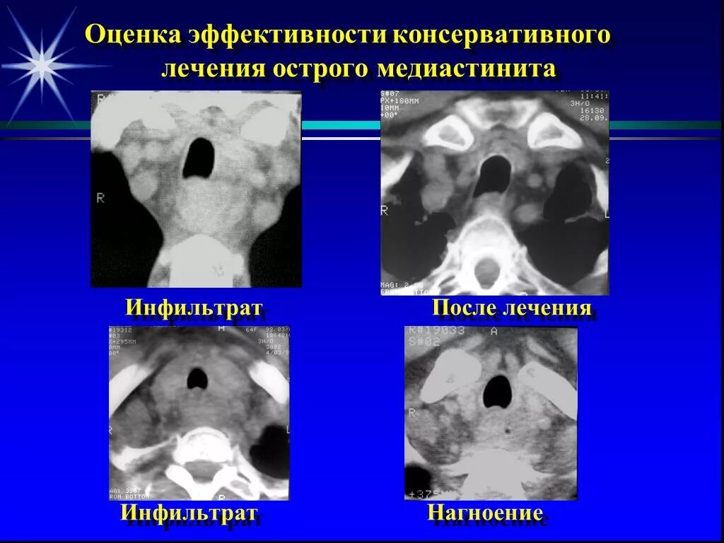 Медиастинит лечение. Медиастинит заднего средостения. Гнойный медиастинит рентген. Фиброзирующий медиастинит. Гнойный медиастинит симптомы.