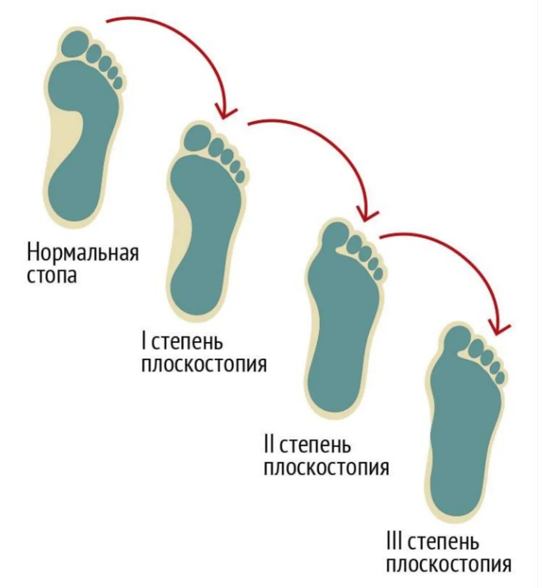 Степени плоскостопия. Плоскостопие 2 степени что это. Продольное плоскостопие 3. Степени плоскостопия. Плоскостопие высота свода стопы.