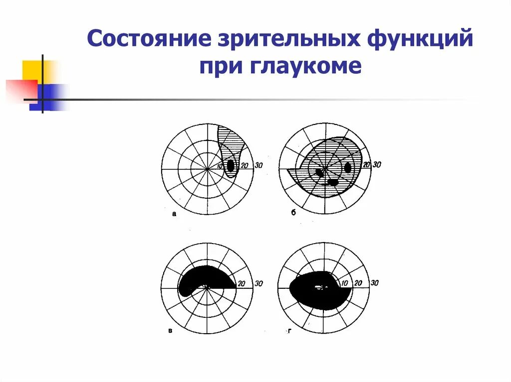 Оценка состояния зрительных функций глаза. Состояние зрительной функции. Динамика зрительных функций при глаукоме. Классификация по состоянию зрительной функции. Классификация глаукомы