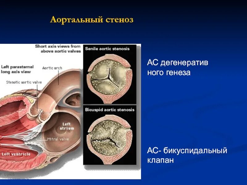 Впс двустворчатый аортальный клапан. Порок сердца двустворчатый аортальный клапан. двустворчатый клапан аорты,стеноз аортального клапана. двустворчатый аортальный клапан классификация. типы двустворчатого аортального клапана.