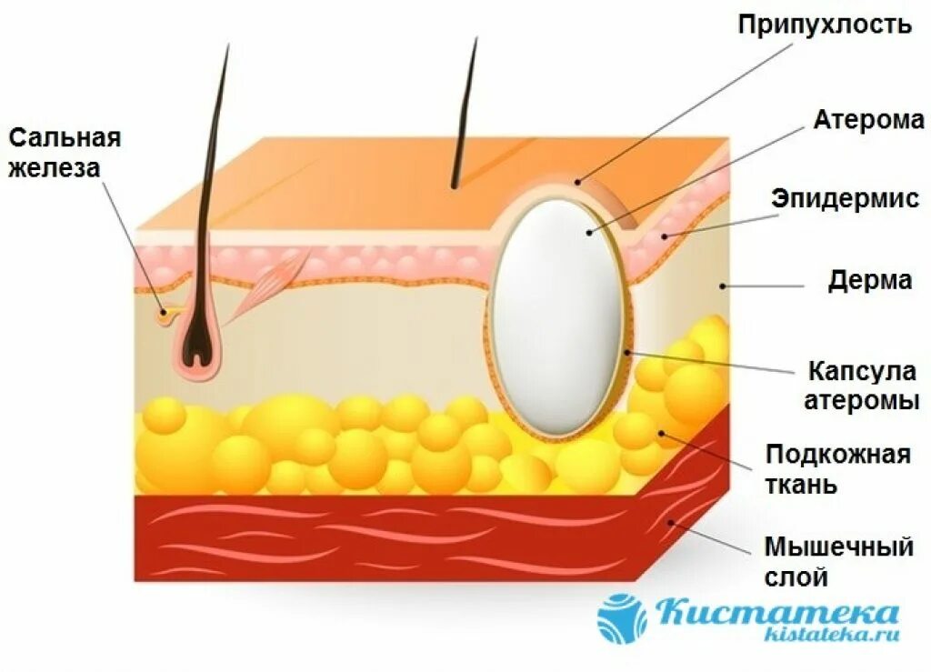 Атерома киста сальной железы. Закупоривание сальных желёз. Капсула жировика