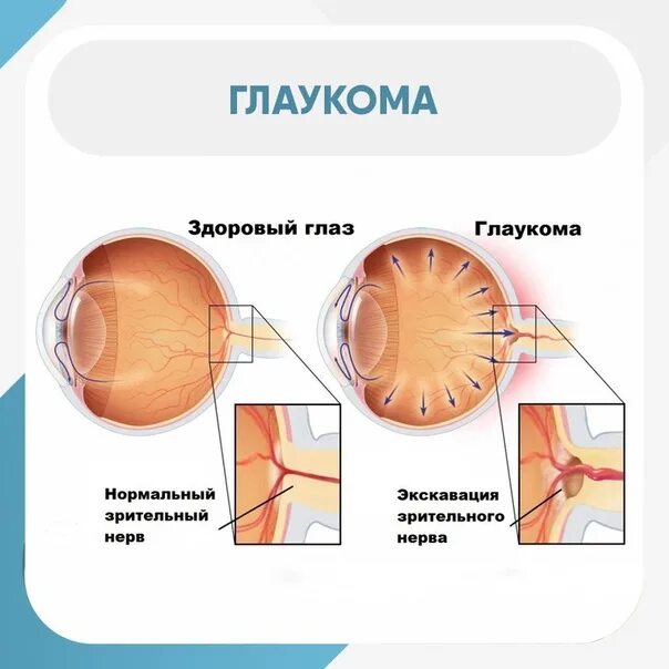 Стабилизированная глаукома. Глаукома глаза симптомы.