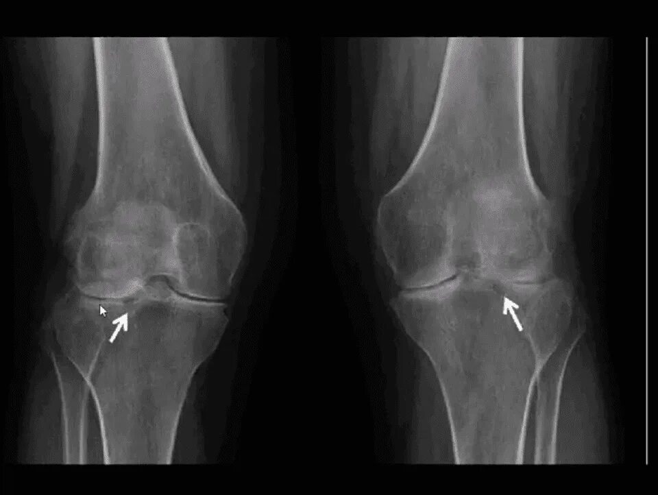 Артрит кт. Ревматоидный артрит коленного сустава кт. Ревматоидный артрит коленного сустава рентген. Периартрит коленного сустава рентген. Обызвествление кисты Бейкера рентген.