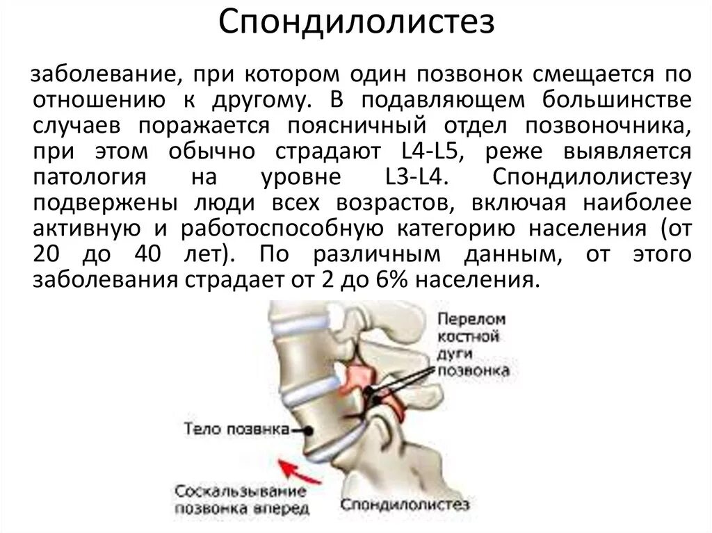 Спондилолистез 4 позвонка 1 степени. Спондилолистез l4 позвонка 1 степени. Смещение позвонков l4 l5. Смещение 4 позвонка поясничного отдела симптомы. Операция смещение позвоночника