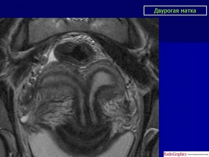 Двурогая матка у женщин