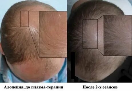 Плазма в кожу головы