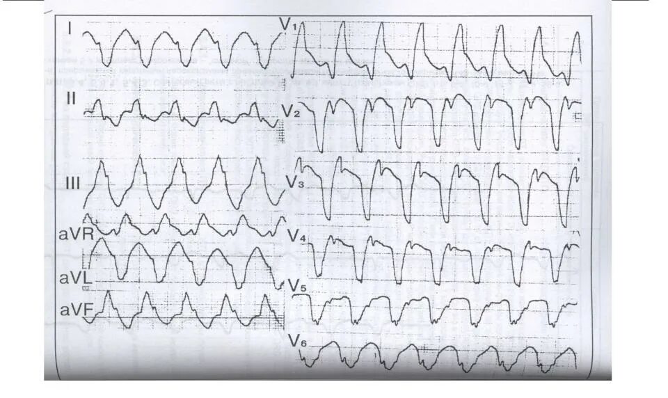 Желудочковая тахикардия на экг. Фасцикулярная желудочковая тахикардия на ЭКГ. Желудочковая тахикардия с ЧСС 190. Мономорфная желудочковая тахикардия ЭКГ. Окс с желудочковой тахикардией.