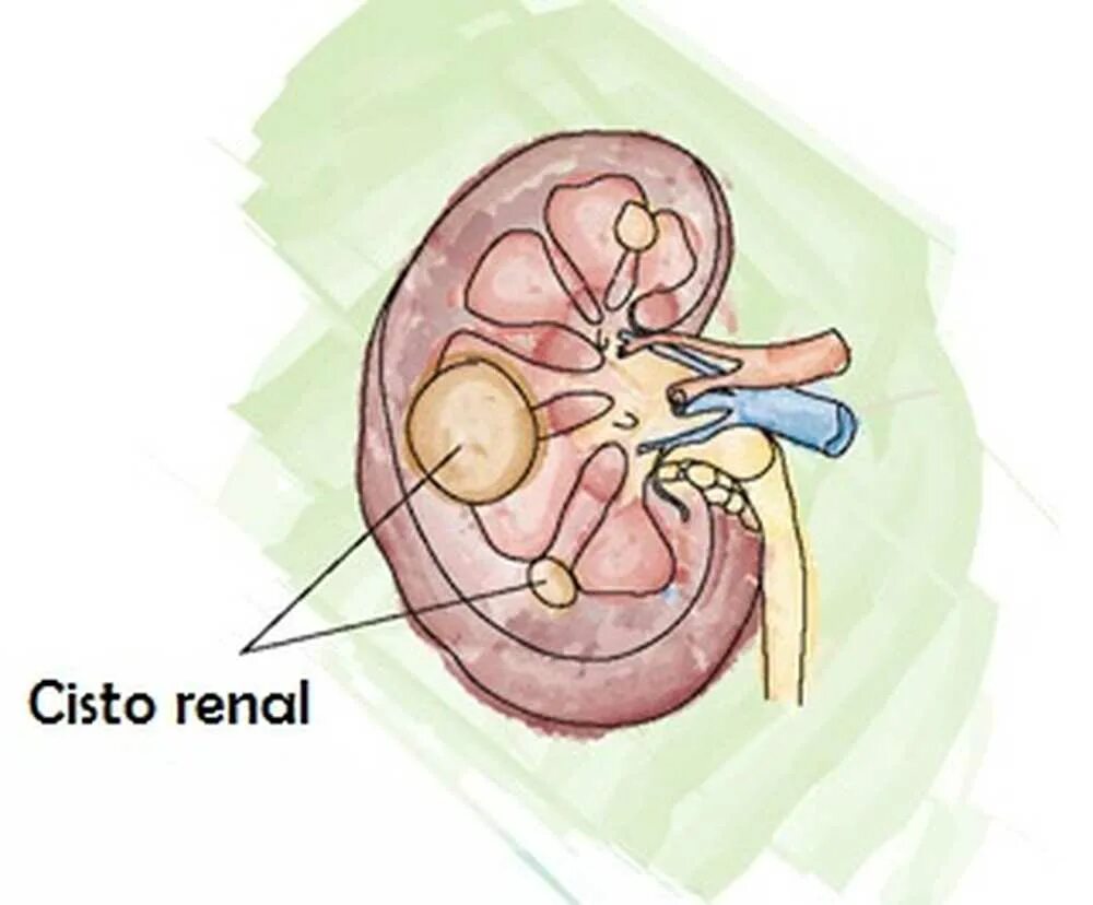 Киста в почке лечение у взрослых женщин. Двухсторонний киста почек.