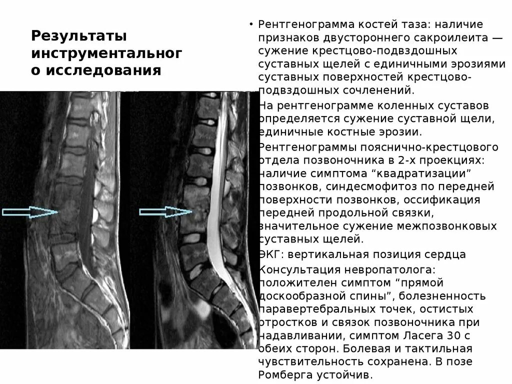 Мр картина дистрофических изменений поясничного отдела позвоночника. Сужение суставных щелей межпозвонковых суставов. Дегенеративные изменения позвоночника. Крестцово подвздошных суставов рентгенограмма. Пояснично-крестцовый отдел позвоночника + сакроилеальные сочленения.