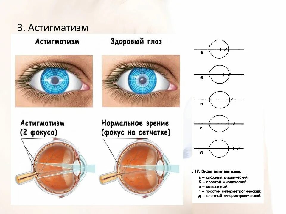 Как можно скорректировать зрение при помощи линз. Линзы для сложного миопического астигматизма. Сложный гиперметропический астигматизм у детей в 1 год. Линзы -2.25 и -2.5 астигматизм. Сложный миопический астигматизм степени.