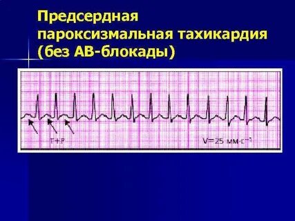 Тахикардия 90