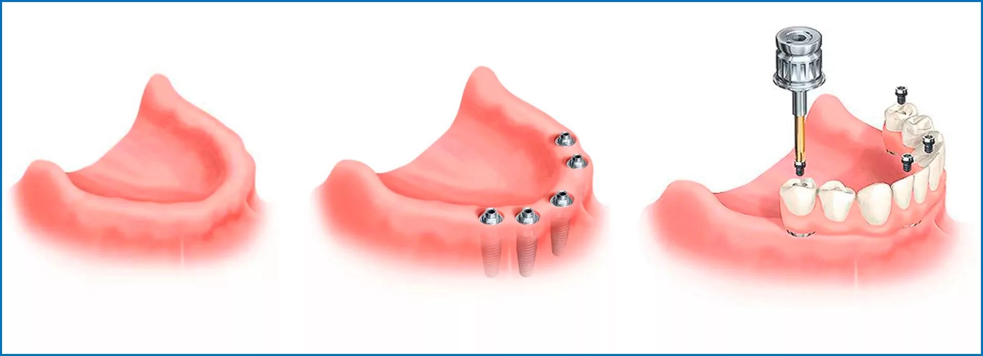 Условно-съёмный протез ( all-on-4). Протез на 2 имплантах на нижнюю челюсть. Резекционный протез на нижнюю челюсть. Протез на 2 имплантатах на нижней челюсти. Как крепятся съемные