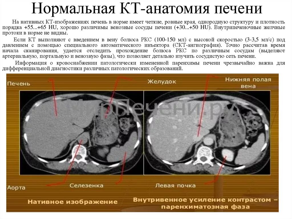 Плотность печени на кт норма. Размеры печени на кт норма. Краниокаудальный размер печени на кт. Печеночные вены анатомия кт. Кт норма печень