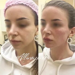 Щечный коридор при улыбке это