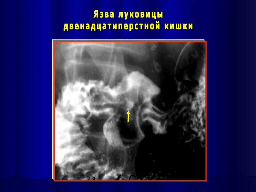 Рубцовая деформация луковицы дпк что это. Язва луковицы двенадцатиперстной кишки. острая язва луковицы дпк. рубцовая деформация луковицы дпк.