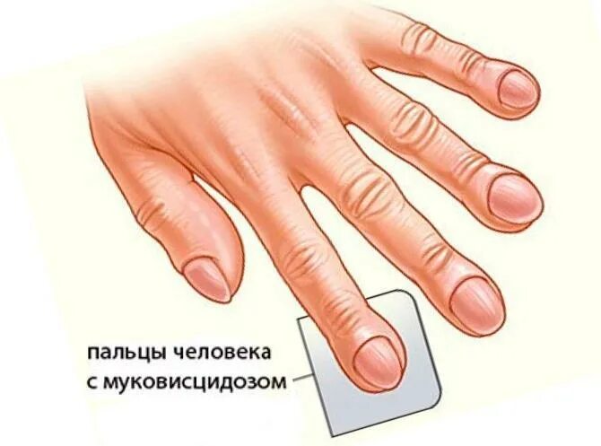 Симптом часовых. Муковисцидоз симптом барабанных палочек. барабанные палочки пальцы гиппократа. пальцы барабанные палочки муковисцидоз. синдром барабанных палочек пальцы.
