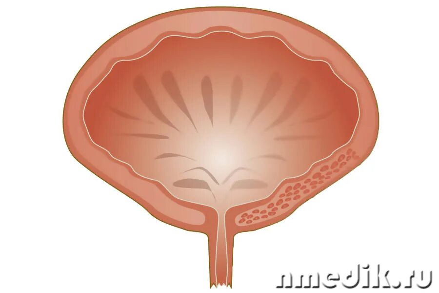 Детрузора мочевого пузыря. Атония детрузора мочевого пузыря. Мочевой пузырь рисунок. Гипертрофия детрузора.
