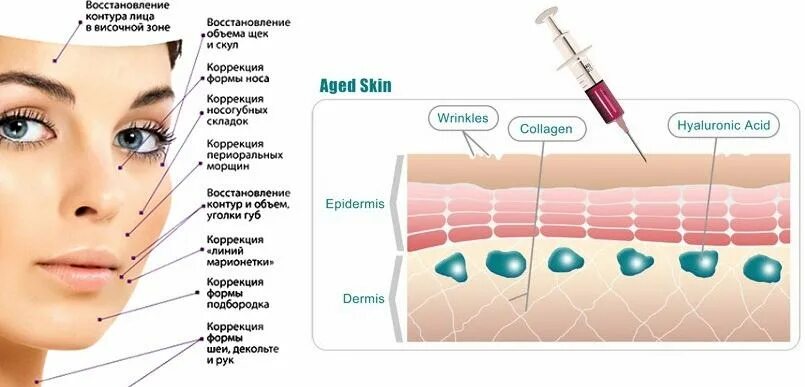 Схема введения гиалуроновой кислоты на лице. Схема биоревитализации лица. Методика введения филлера в губы. Зоны биоревитализации лица.