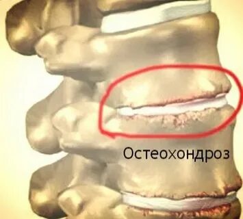 Остеохондроз 1 шейного отдела