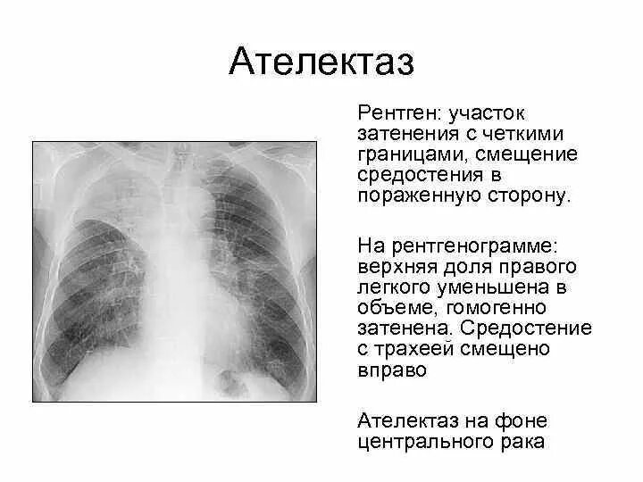 Признаки ателектаза легкого. Ателектаз верхней доли рентген. Ателектаз верхней доли легкого рентген. Ателектаз средней доли правого лёгкого рентген. Ателектаз нижней доли рентген.