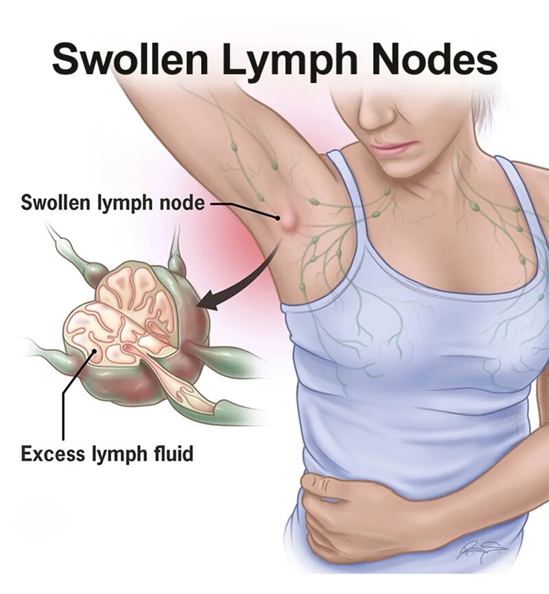 Лимфатические узлы под мышкой. Подмышечные лимфатические узлы расположение. Схема лимфоузлов под мышкой. Подмышкой лимфатический узел. Жидкость в лимфоузле