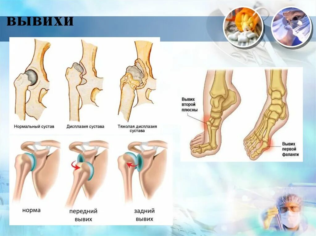 Вывихи суставов классификация. Вывихи и подвывихи классификация. Травматические и патологические вывихи. Патологический вывих бедра.