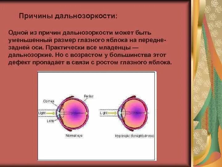 Причины возникновения дальнозоркости. Причины дальнозоркости. Причины возникновения дально. Причины развития дальнозоркости. Причины появления дальнозоркости.