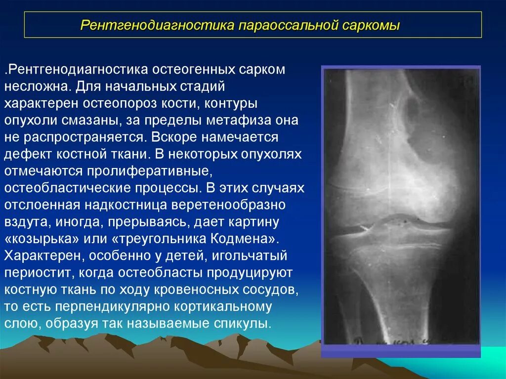 Виды сарком. Гигантоклеточная опухоль малоберцовой кости. Остеосаркома остеобластическая форма. Рентгенодиагностика опухолей костей. Опухоли костей рентгендиагностик.