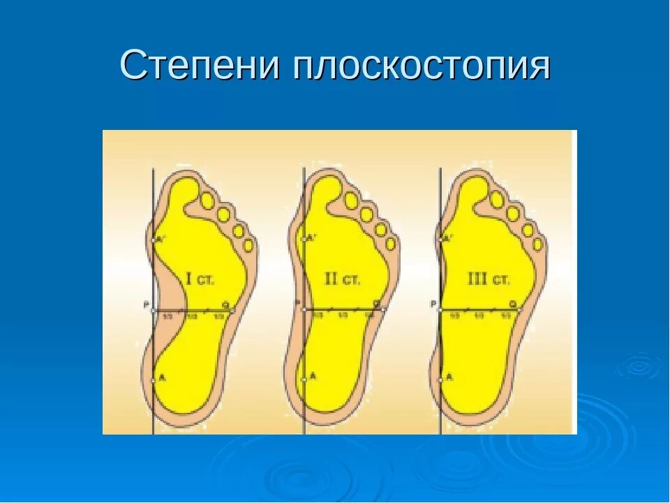 Продольное плоскостопие 2. Поперечное iii - iv степени плоскостопие. плоскостопие 3 степени вид сбоку. степени плоскостопия вид сбоку. продольное плоскостопие 1.
