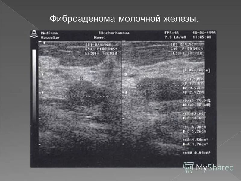 дренаж в молочной железе. фиброаденома молочной железы клиника. фиброаденома баня. узи грудных желез санкт-петербург. фиброаденома баня.