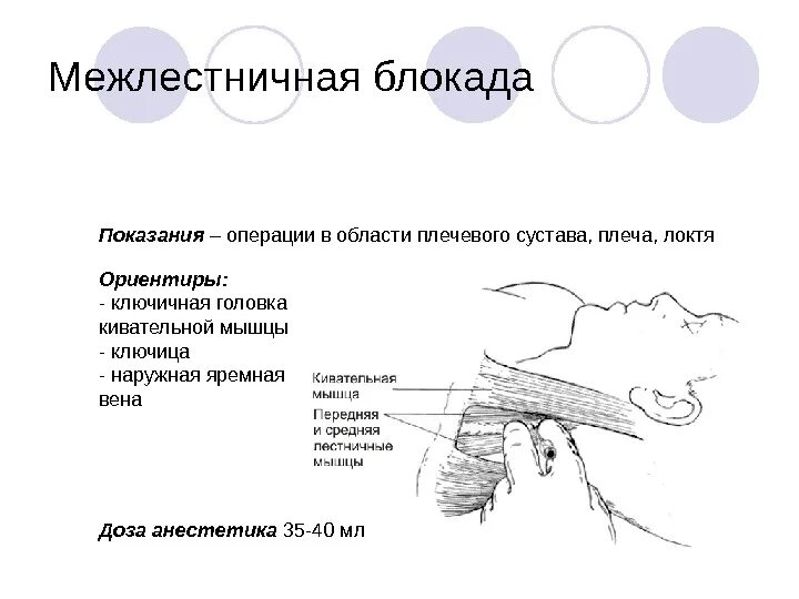 Блокада сплетения. Регионарная анестезия плечевого сплетения. Проводниковая анестезия плечевого сплетения межлестничный доступ. Блокада плечевого сплетения межлестничным доступом техника. Межлестничная блокада плечевого сплетения методика.