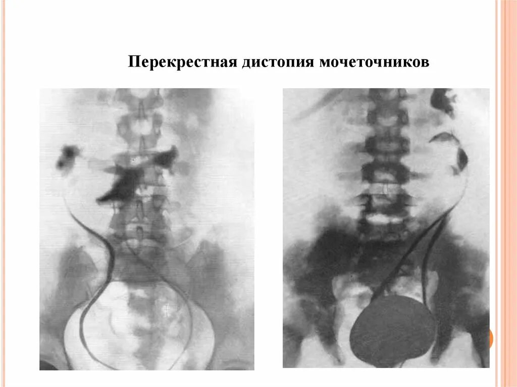 Развитие мочеточников. Дистопия почки урография. Аномалии развития мочеточников. Дивертикул мочеточника на кт.