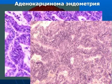 Аденокарцинома эндометрия матки