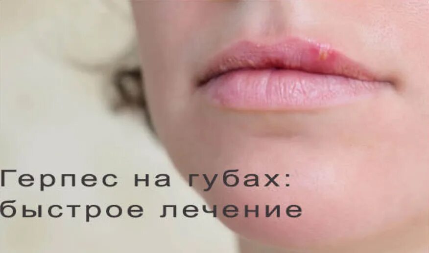 Герпес как быстро вылечить за 1 день. Как выглядит простуда на губе. простудный герпес на губах.