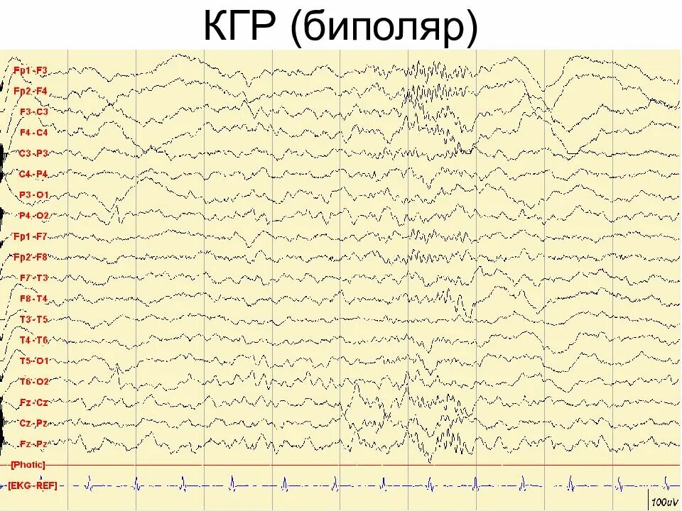 Запись на ээг. Кожно гальваническая реакция на ЭЭГ. Артефакты ЭЭГ. Кгр на ЭЭГ. ЭЭГ Nicolet.