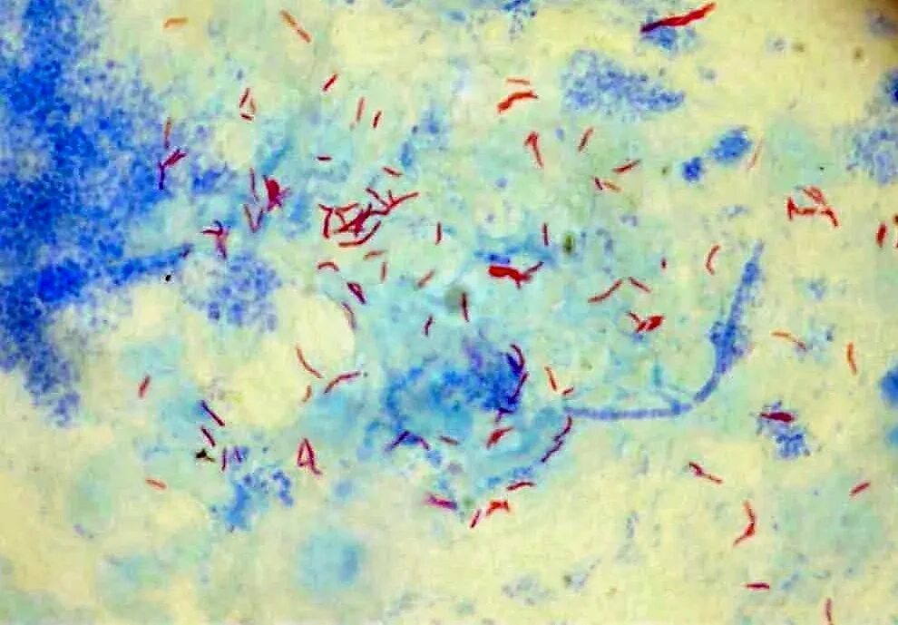 Микобактерия туберкулеза по Цилю Нильсену. Микобактерии туберкулеза микроскопия по Цилю Нильсену. Микобактерии туберкулеза микроскопия. Палочка Коха по Цилю-Нильсену.
