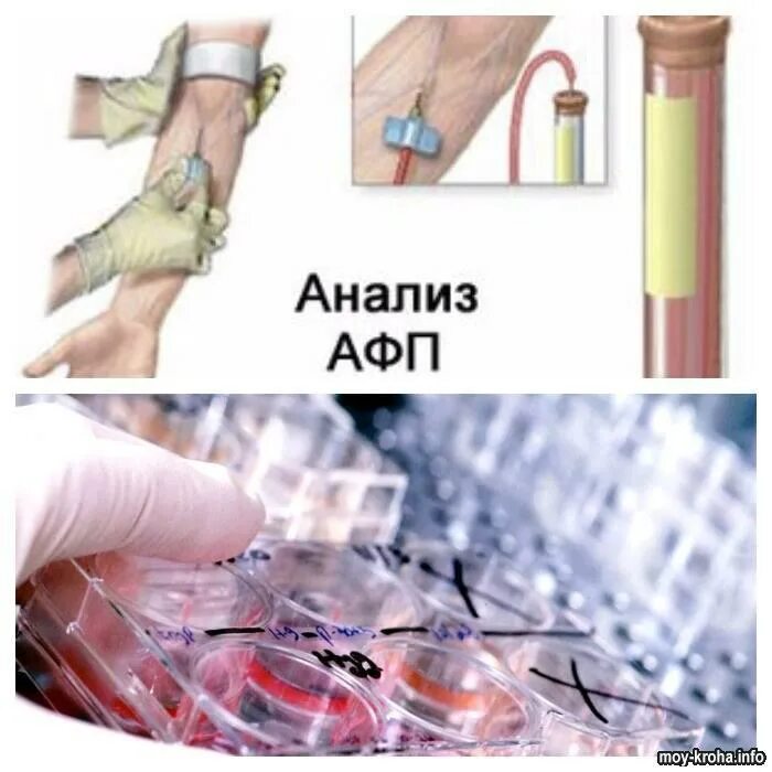 Альфа фетопротеин норма у женщин. Альфа-фетопротеин (АФП). Анализ на Альфа-фетопротеин (АФП). Исследование Альфа-фетопротеина норма. Исследование АФП В крови что это.