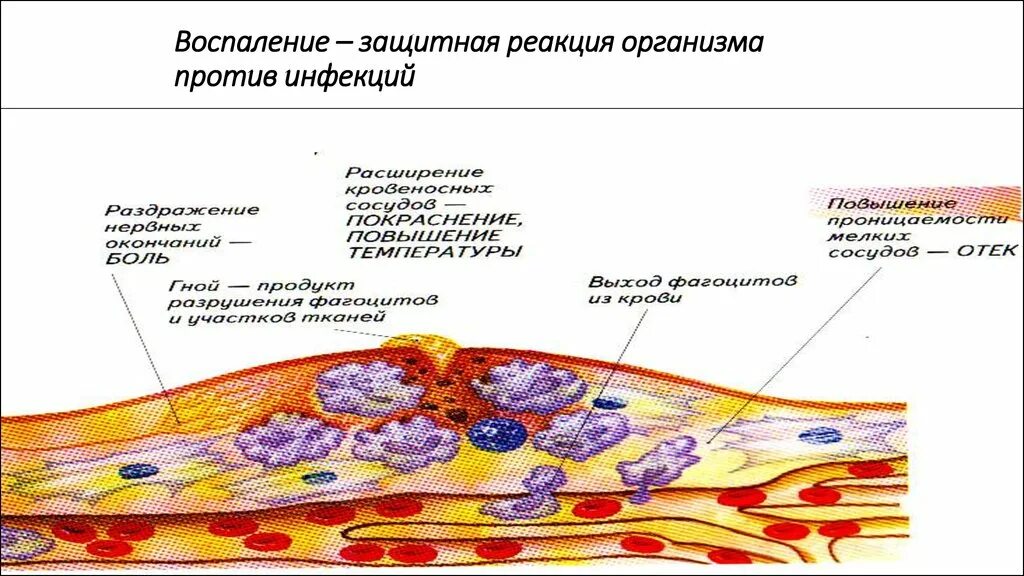 Стадии воспалительного процесса схема. Воспаление это защитная реакция организма на. Механизм воспалительной реакции физиология. Реакция воспаления процесс. Реакция организма клетки на