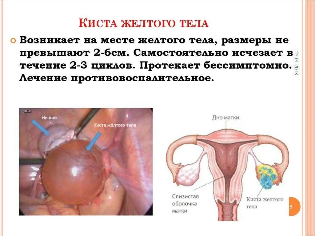 Киста желтого тела правого яичника. Киста желтого тела яичника дифференциальная. Киста желтого тела правого яичника 6 см. Киста желтого тела яичника возникает.