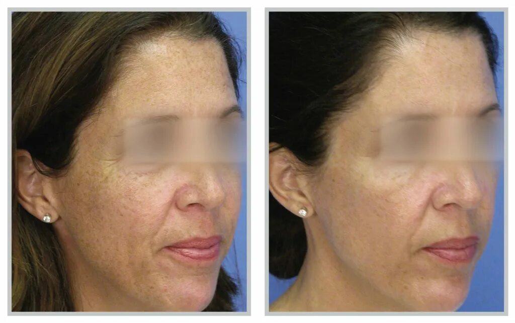 Термолифтинг BBL Skin Tyte II. Лазерный пилинг MICROLASERPEEL.