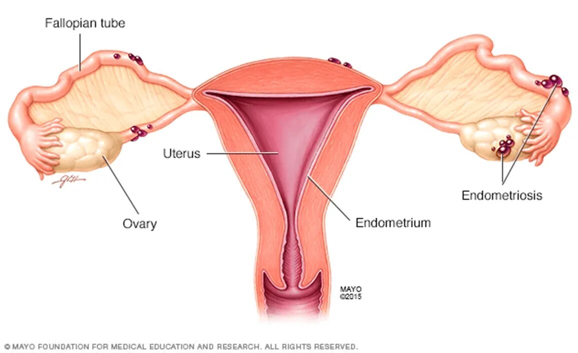 Женская половая труба. Эндометриоз яичников маточных труб. Эндометриоз маточных труб. Эндометриоз фаллопиевых труб.
