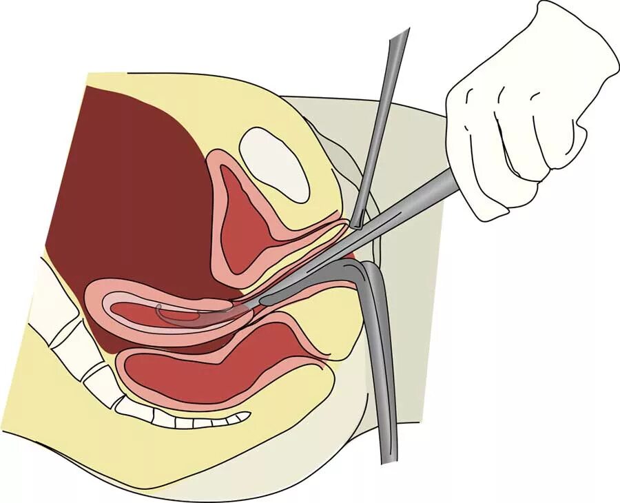 Диагностическое выскабливание матки и цервикального канала